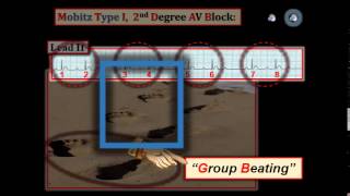 ECG Video8 Blog 105  AV Block 12512015 [upl. by Analli840]