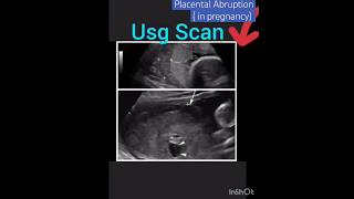 Pregnancy ultrasoundplacental abruptionabruptio placentaebleeding in pregnancyytshort [upl. by Harl]