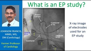 What is an EP study [upl. by Eendys]