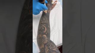 How to remove a Permanent Tattoo Laser vs Tattoo ☠️ [upl. by Gosnell642]