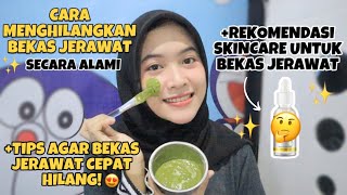 CARA MENGHILANGKAN BEKAS JERAWAT DENGAN CEPAT SECARA ALAMI  REKOMENDASI SKINCARE  indri meiliana [upl. by Hgielrahc997]