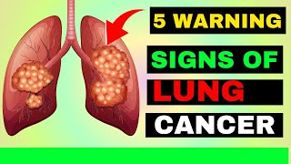 5 WARNING SIGNS OF LUNG CANCER [upl. by Otrebtuc]