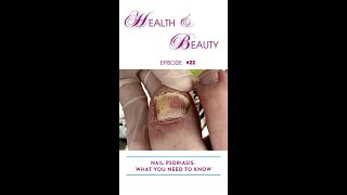 Nail Psoriasis What You Need to Know [upl. by Berthold]