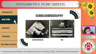 Constrictive pericarditis [upl. by Mason474]