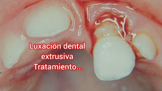 Luxación dental extrusiva y su tratamiento [upl. by Anerbes610]