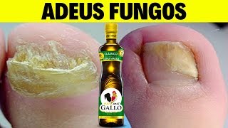 NUNCA  você vai ter FUNGOS basta isso Remédio Natural para Micose nas Unhas [upl. by Anilek]