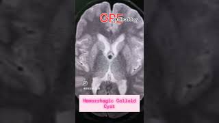 Hemorrhagic colloidCyst foramen of Monroe neuroradiology mri ventricle s9teleradiology cns [upl. by Romeu]