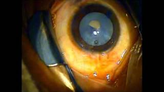 Capsulorhexis and phaco of a brunescent intumescent cataract [upl. by Adekram]