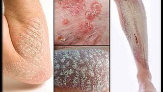 Types of Psoriasis [upl. by Carlisle37]