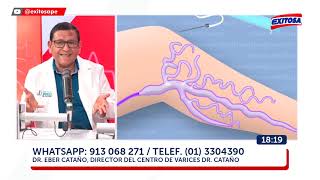 LAS VÁRICES Y LA ESCLEROTERAPIA  Dr Eber Cataño en Exitosa [upl. by Jeraldine]