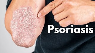 Psoriasis kya hai  Psoriasis kyu hota hai  Psoriasis ka ilaj  Psoriasis symptoms treatment [upl. by Fleisher]