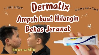 Dermatix Ampuh buat Hilangin Bekas Jerawat [upl. by Bellina]