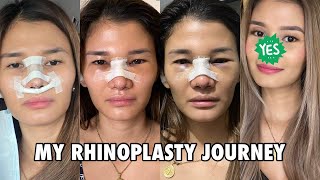 MY RHINOPLASTY JOURNEY  Was it worth it  Jen Barangan [upl. by Jewel]