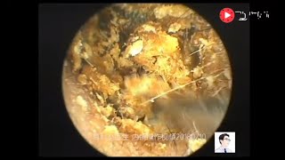 Removal of external auditory canal cholesteatoma by ear endoscopy 19 minutes [upl. by Reisinger]