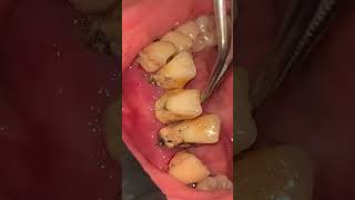 Cleaning and scaling teeth amp tartar amp calculus dentist dental dentista teethcare smileteethcare [upl. by Ayhtin660]