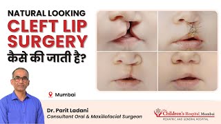 Cleft Lip and Palate Surgery which looks Natural by Dr Parit Ladani [upl. by Anirbas]