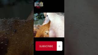 how to remove blackheads and whiteheads on face easy [upl. by Artep]