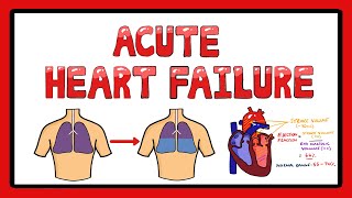 Acute Heart Failure  Types of Acute Heart Failure  Causes  Signs and Symptoms [upl. by Coco713]