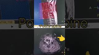 Potts spine bone TB shortvideo viralshorts [upl. by Wichman]