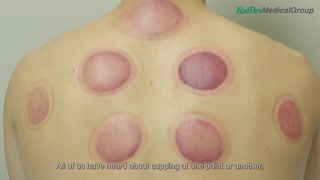 What You Need to Know about Cupping [upl. by Sarah]