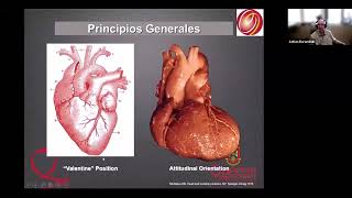 EXTRASÍSTOLES VENTRICULARES LOCALIZACIÓN MEDIANTE ECG DE SUPERFICIE PREPARANDO LA ABLACIÓN [upl. by Caty]