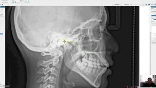 Tutorial para hacer una cefalometria digital Nemoceph [upl. by Anneehs]