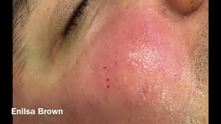 Christians Acne Treatment  Blackheads Extractions [upl. by Petula]