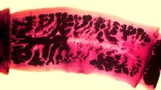 Cysticercosis of the Humanoid Nervous System [upl. by Hewet]