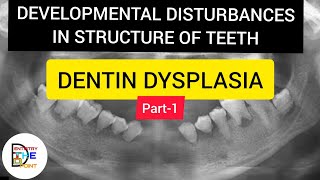 DENTIN DYSPLASIA ROOTLESS TOOTH PART1 Developmental Disturbances of structure of teeth [upl. by Suirada]