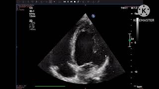 Hypertensive CMP due to fibromuscular dysplasia of renal artery [upl. by Chaille53]