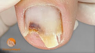 Trimming and cleaning this problematic toenail  Podología Integral [upl. by Elletsirk]