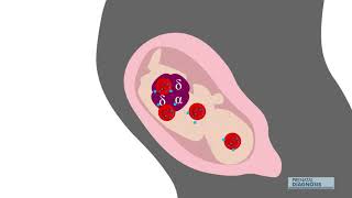 In utero transfusion gives meaningful survival to fetuses with alpha thalassemia major [upl. by Yoo]