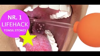 How To Remove Tonsil Stones In Just 60 Seconds Best 1Minute Lifehack  Cure Bad Breath At Home [upl. by Lasorella]