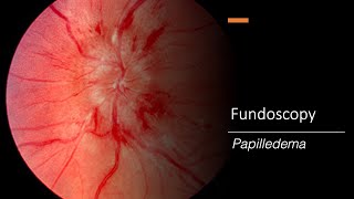 Papilledema Fundoscopy [upl. by Etaner]