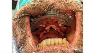 GuidedSMILE Dentate Maxilla Nobel FP3  Dr Fried [upl. by Valerie728]