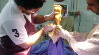 Percutaneous Achilles tenotomy procedure2 [upl. by Bilat592]