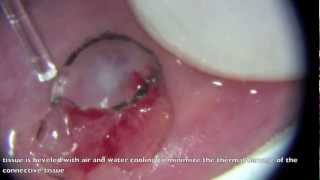 laser enhanced removal of mucous retention cyst [upl. by Ytsrik905]