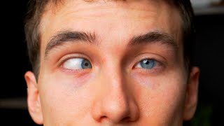 CROSS EYED What is Strabismus  Types Causes Treatments Eye Doctor Explains [upl. by Gerome241]