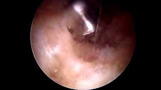 RECTUS FEMORIS CALCIFICATION the extracapsular approach for hip arthroscopy [upl. by Lauer414]