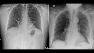 Hemothorax pneumothorax pleural effusion [upl. by Sams]