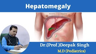 Hepatomegaly Enlargement of liver  Deepak PD Singh [upl. by Arymas]