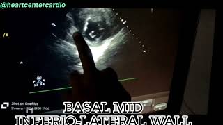 SEVERE CHEST PAIN WITH SWEATING ECG Acute inferioposterior wall MI [upl. by Ivette]