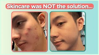 Confused sa pag treat ng ACNE Start here Beginners Guide  Jan Angelo [upl. by Yellhsa750]