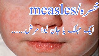 Measles  causes symptoms diagnosis treatmenthealthology by Dr junaid [upl. by Kazimir]