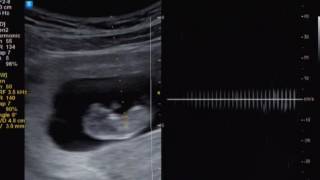 Ultrasound heartbeat checking 2month pregnant [upl. by Mora961]