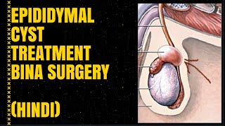 Epididymal cyst ka ilaaj bina surgery  Hindi [upl. by Apilef]