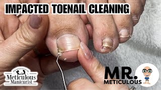 How to Fix Ingrown  Impacted Toenails at Home nails satisfying [upl. by Bullen]