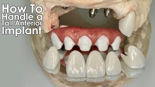 How to Handle a Tall Anterior Zirconia Implant [upl. by Clarie]