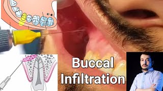 Local Anesthesia Buccal Infiltration Technique Maxillary Anesthesia Techniques dentistry [upl. by Nitz321]