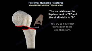 Proximal Humerus Fracture  Everything You Need To Know  Dr Nabil Ebraheim [upl. by Eniahs220]